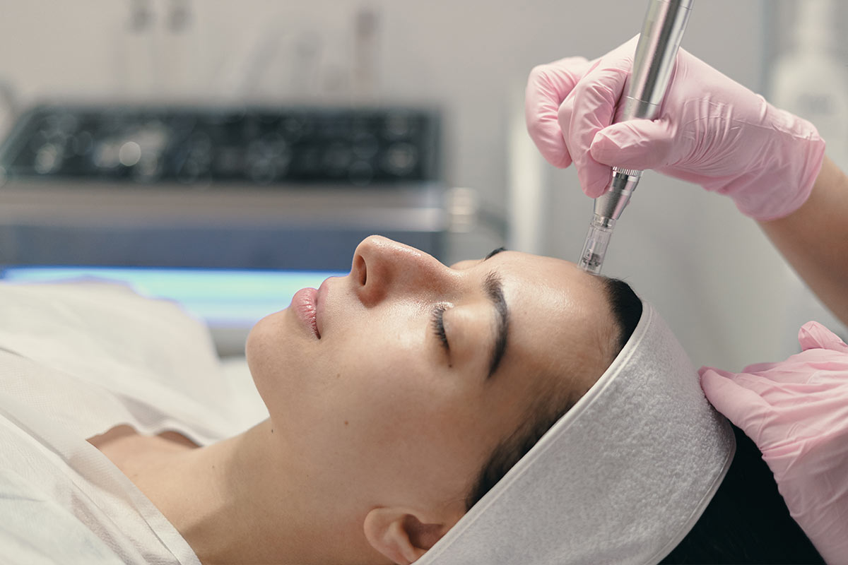 microneedling